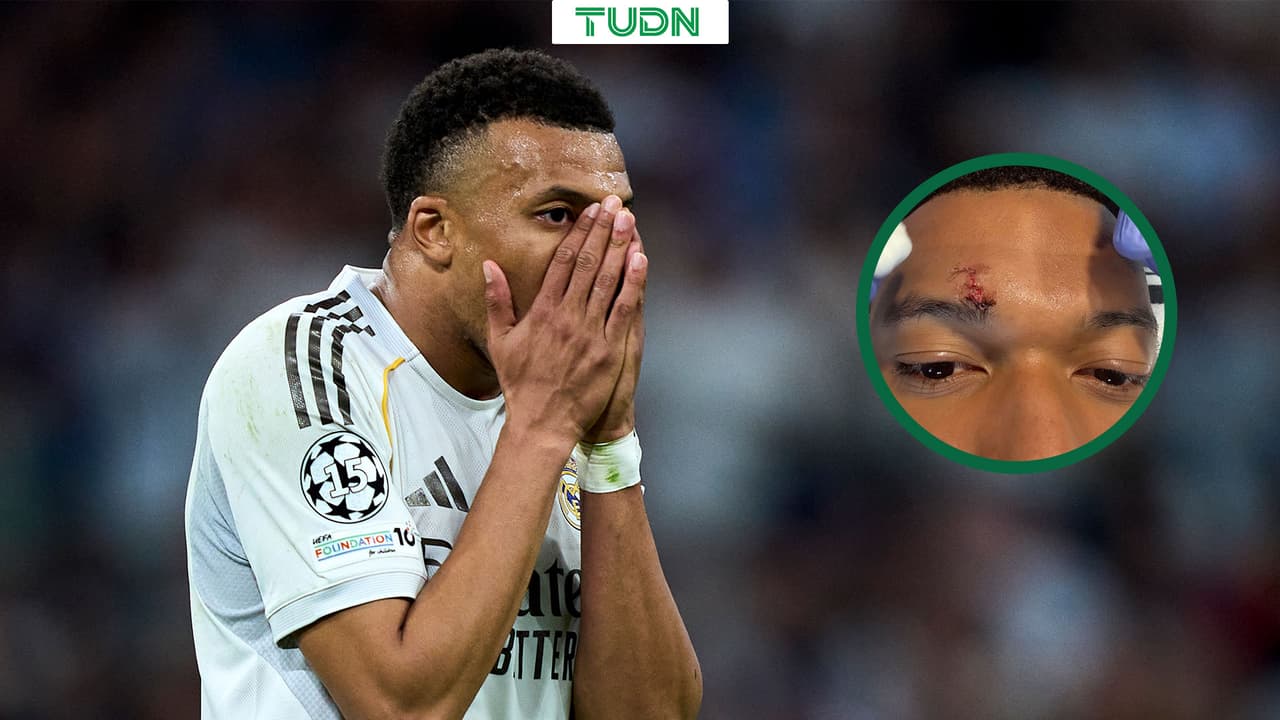Kylian Mbappé recibe tres puntos de sutura sobre la ceja derecha
