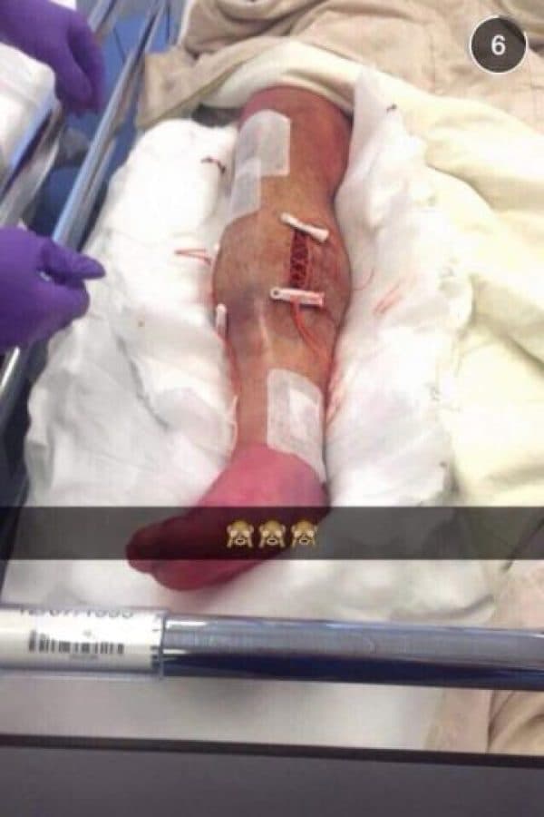 Por una entrada de Héctor Moreno, el inglés Luke Shaw sufrió una tremenda fractura y después de la cirugía para su reconstrucción dejó en sus historias de Instagram esta imagen.