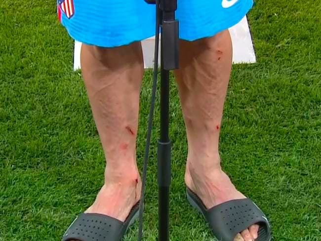 HH muestra cómo quedaron sus piernas tras el Manchester United vs Atleti