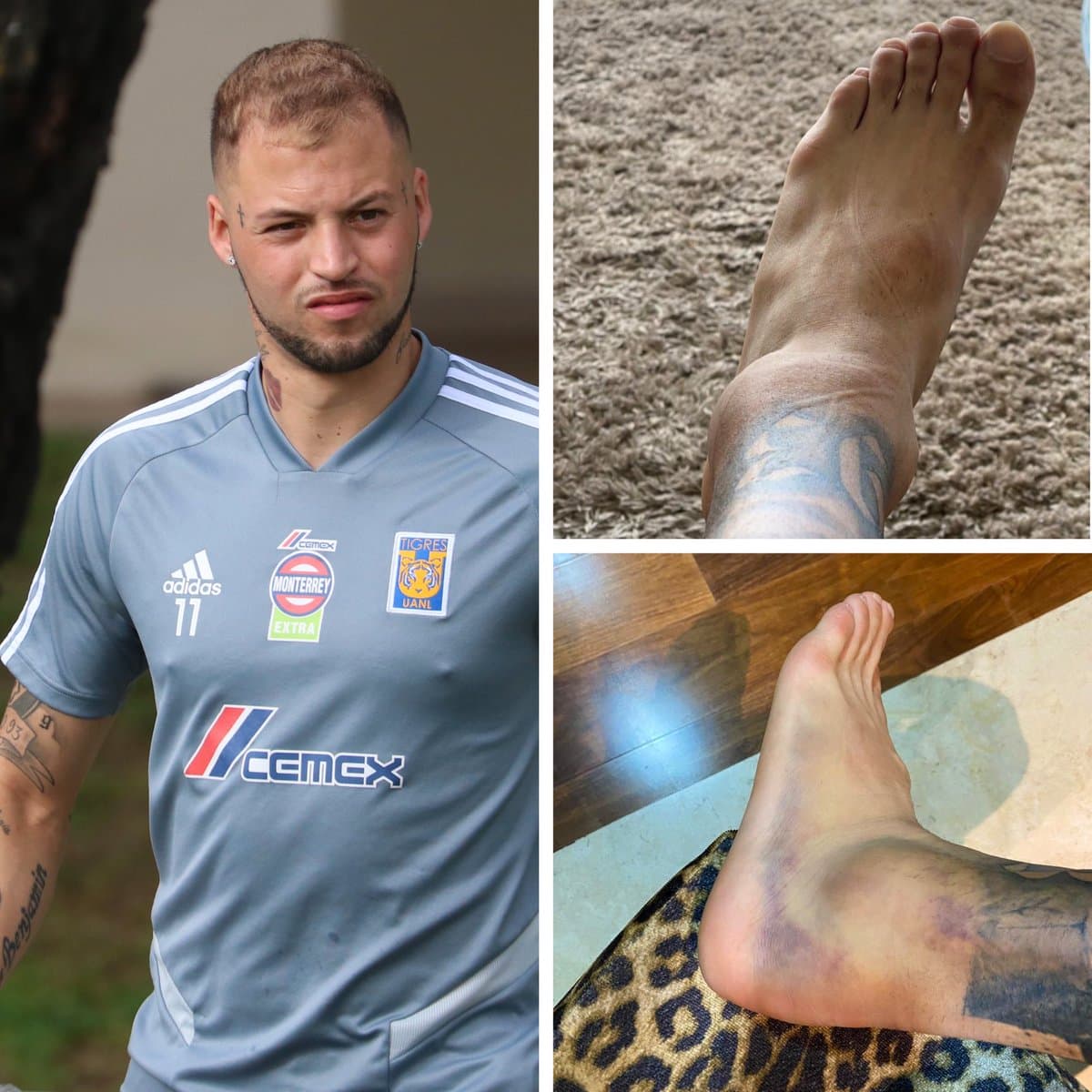Así luce el pie de Nico López tras sufrir una lesión