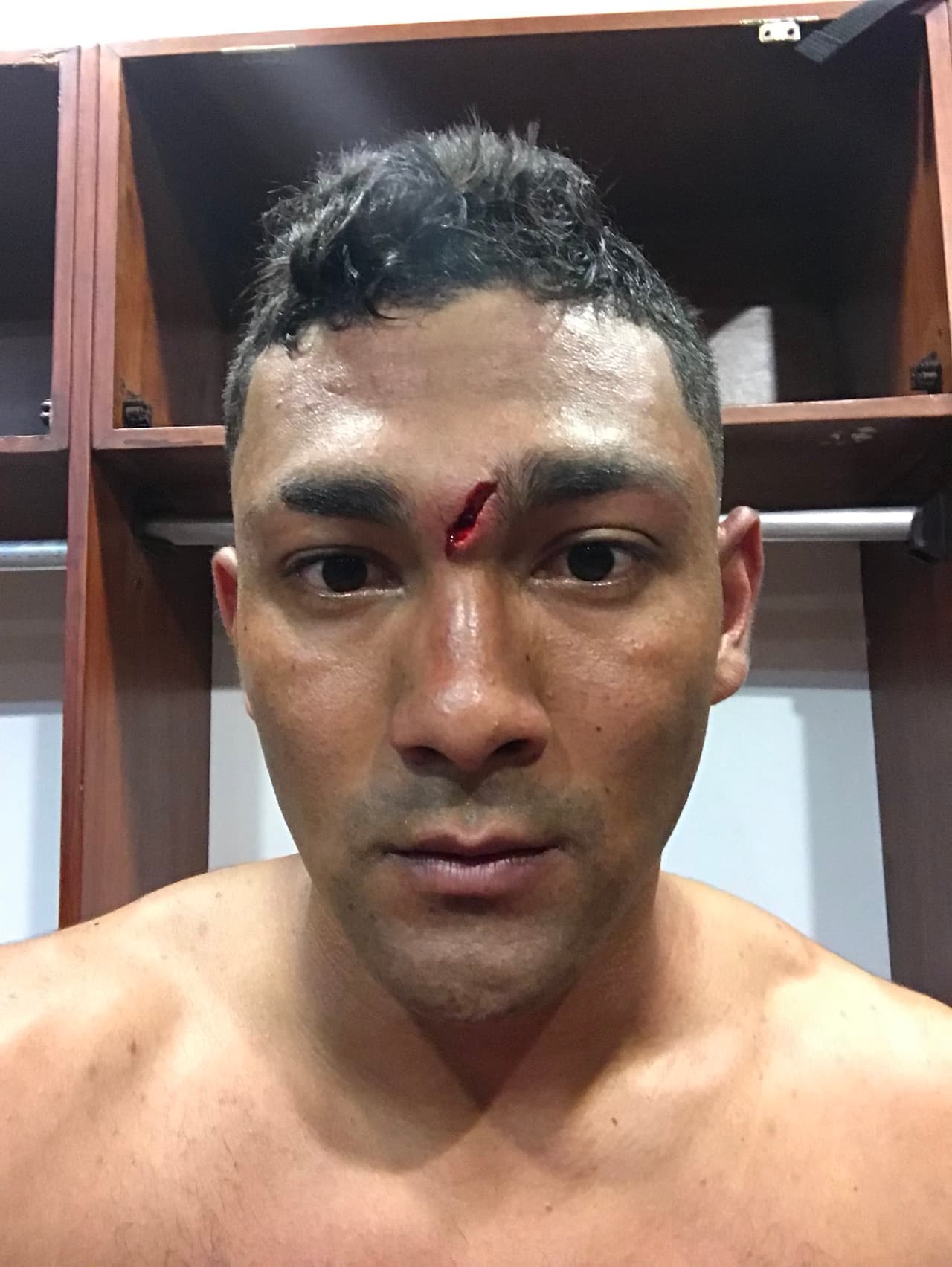Éder Castañeda, colombiano, sufrió un codazo en el rostro durante un juego de la liga de su país. Al agresor no le sacaron ni amarilla y él protestó con esta foto.