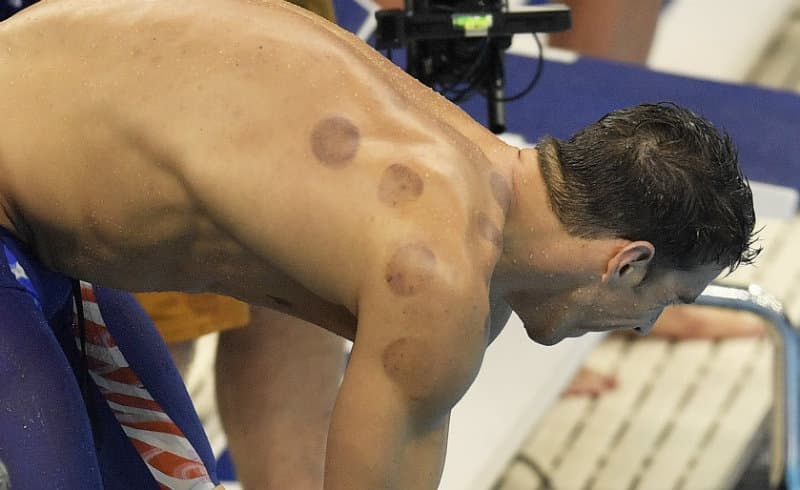 ¿Por qué Michael Phelps tiene marcas redondas en su espalda?