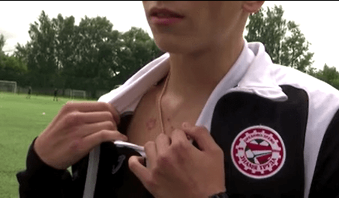 Al joven portero le quedó una cicatriz en el cuello tras haber sido impactado por un rayo.