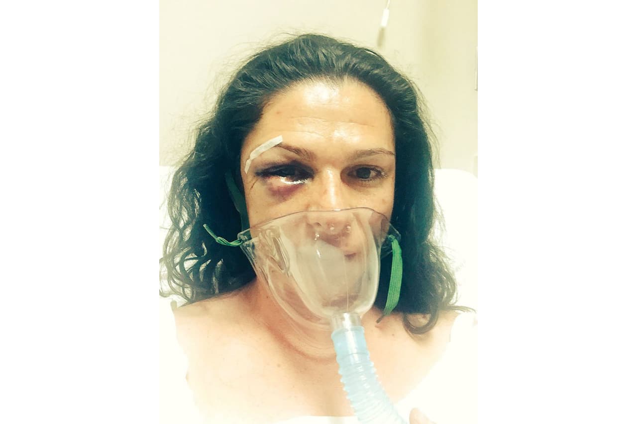 La exvelocista denunció la agresión y mostró esta foto tras su cirugía.