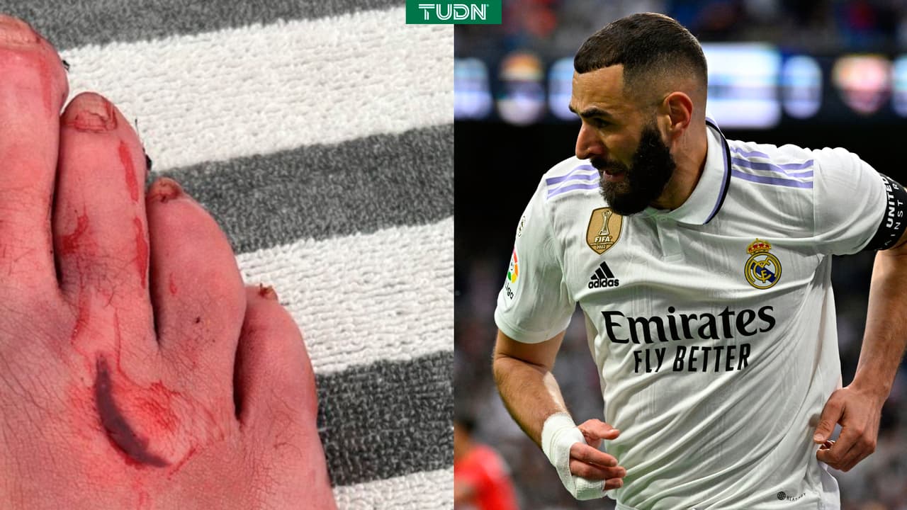 Benzema recibe cinco puntos de sutura tras el juego ante Rayo