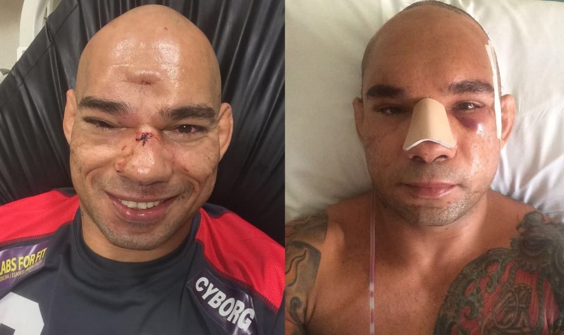 Evangelista 'Cyborg' Santos fue al quirófano 11 días después de la fractura de cráneo que sufrió por un rodillazo de Michael Page durante Bellator 158.