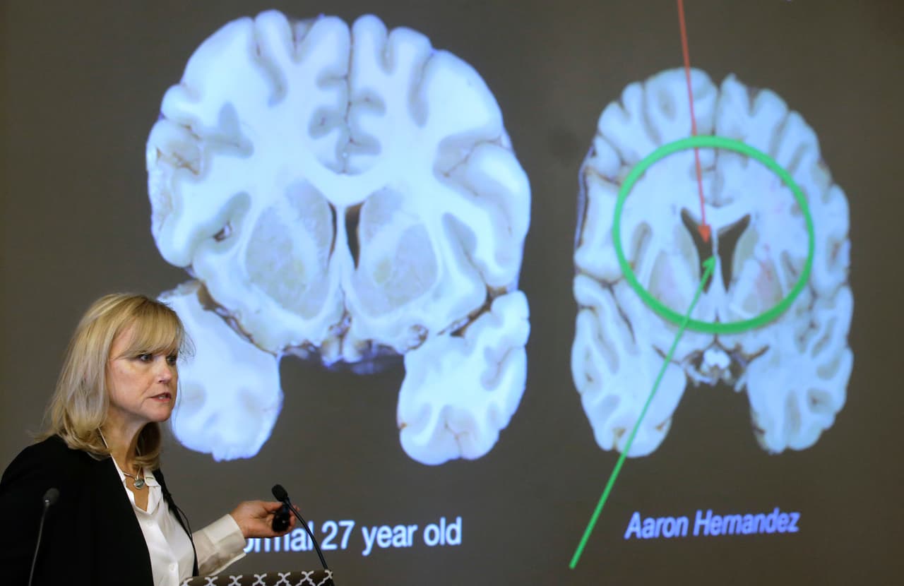 <b>El cerebro de Hernández fue estudiado a profundidad</b>
<br>Ann McKee
<b>,</b> experta en neurología de la Universidad de Boston, después de varias investigaciones y estudios, aseguró que Hernández tenía un deterioro inusualmente extenso en los lóbulos frontales, que son claves para el juicio y la toma de decisiones.
