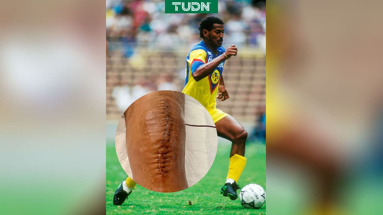 Antonio Carlos Santos recibe prótesis en sus rodillas