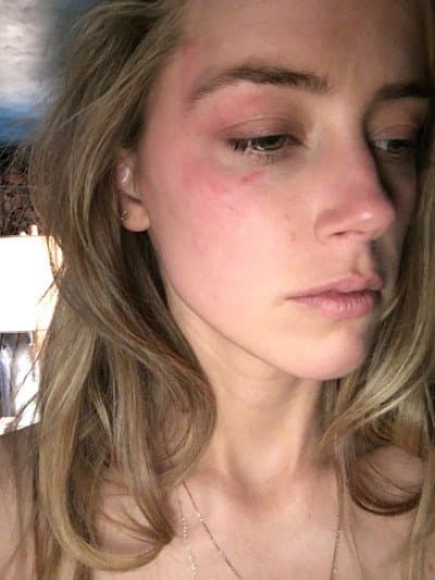 Amber Heard acusó a su exesposo, el también actor Johnny Deep, de haberla golpeado en el rostro, lo denunció y consiguió una orden de restricción para su pareja por parte de la corte de Los Ángeles, California.