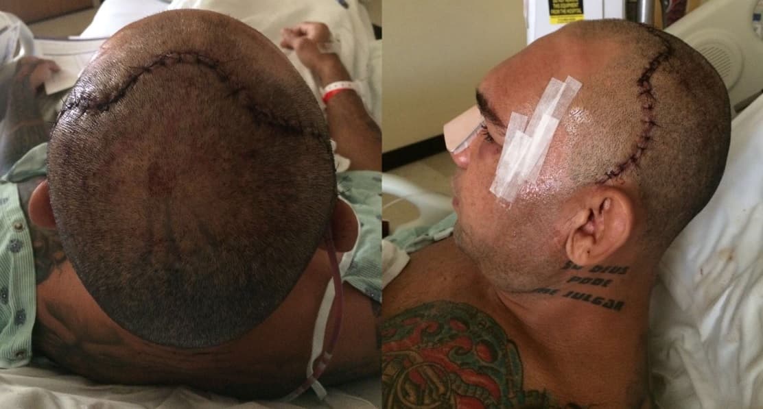 Evangelista 'Cyborg' Santos fue al quirófano 11 días después de la fractura de cráneo que sufrió por un rodillazo de Michael Page durante Bellator 158.