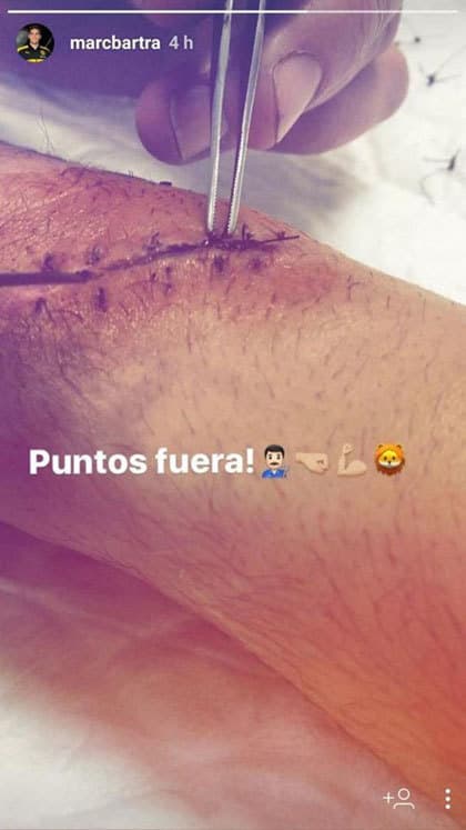 Después del atentado al bus del Borussia Dortmund, en la pasada Champions League, Marc Bartra fue afectado en su brazo. Así compartió el momento en el que le quitaron los puntos.