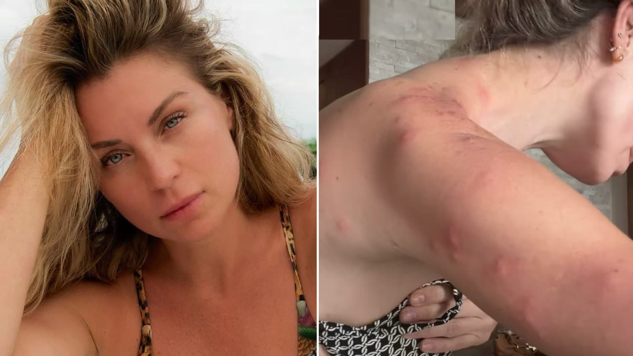 Ludwika Paleta sufre fuertes picaduras durante sus vacaciones: no tiene idea qué la atacó 