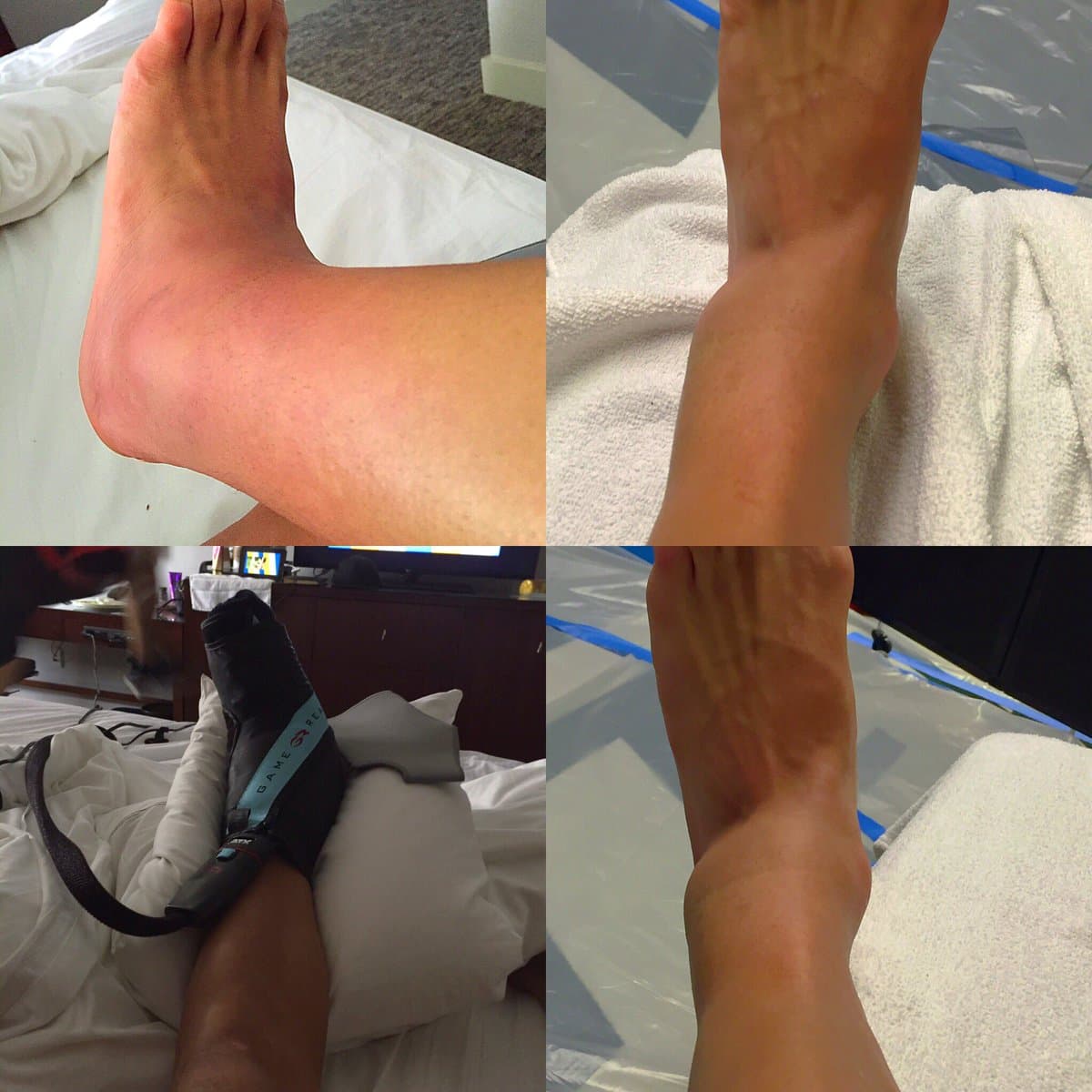 El tobillo hinchado de Alexis Sánchez tras el juego con Argentina.