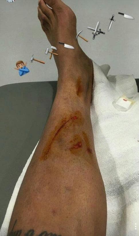 Jugando para el Real Madrid, Danilo recibió una entrada descalificadora en un juego ante Osasuna que le dejó la pierna de esta manera.