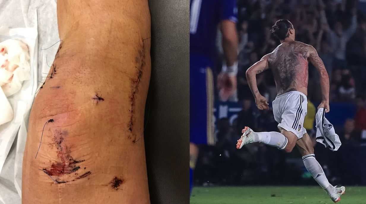 ¿Qué le pasó en la rodilla a Zlatan Ibrahimovic? ¡La escalofriante lesión que casi lo retira!