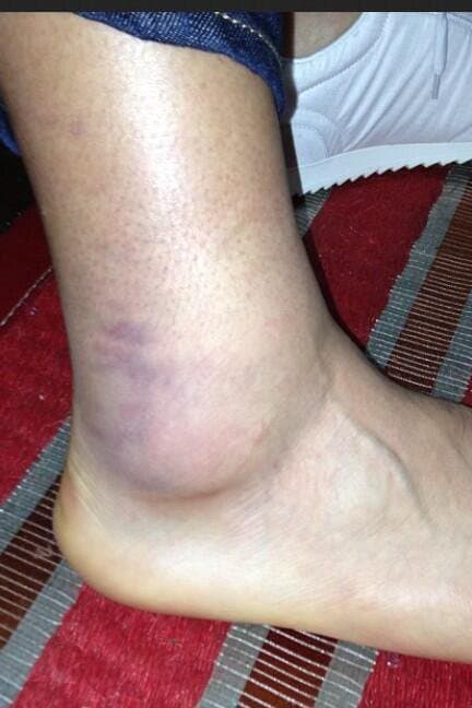 Durante las Eliminatorias a Brasil 2014, el colombiano Falcao García salió maltrecho del partido en Lima contra Perú.