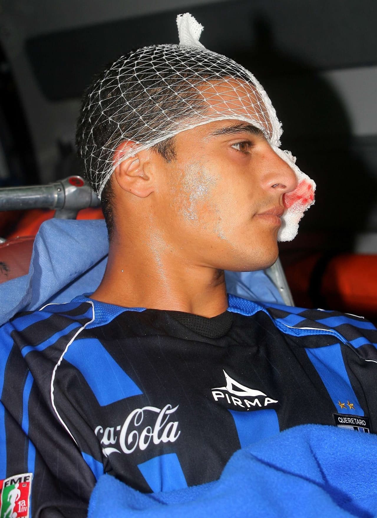 Schneider sufrió desprendimiento de retina y perdió el ojo izquierdo.