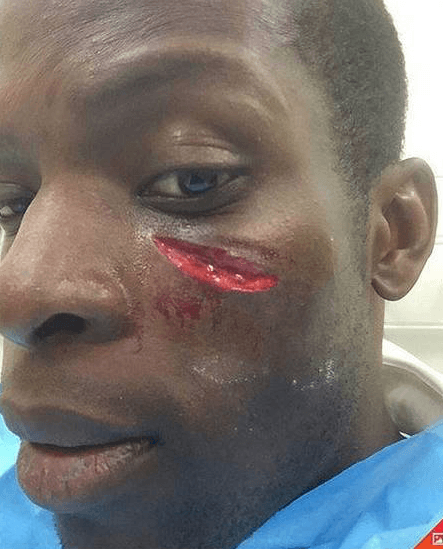 Jugando para los Queens Park Rangers, el defensa Nedum Onuoha recibió un golpe en el rostro que le dejó este recuerdito.