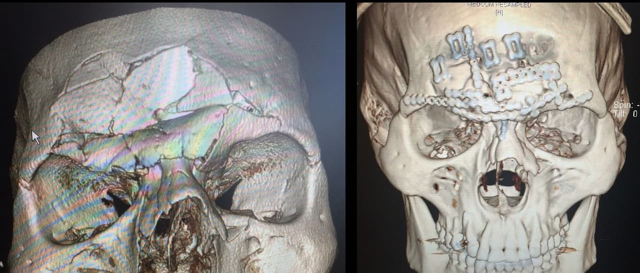 Evangelista 'Cyborg' Santos fue al quirófano 11 días después de la fractura de cráneo que sufrió por un rodillazo de Michael Page durante Bellator 158.