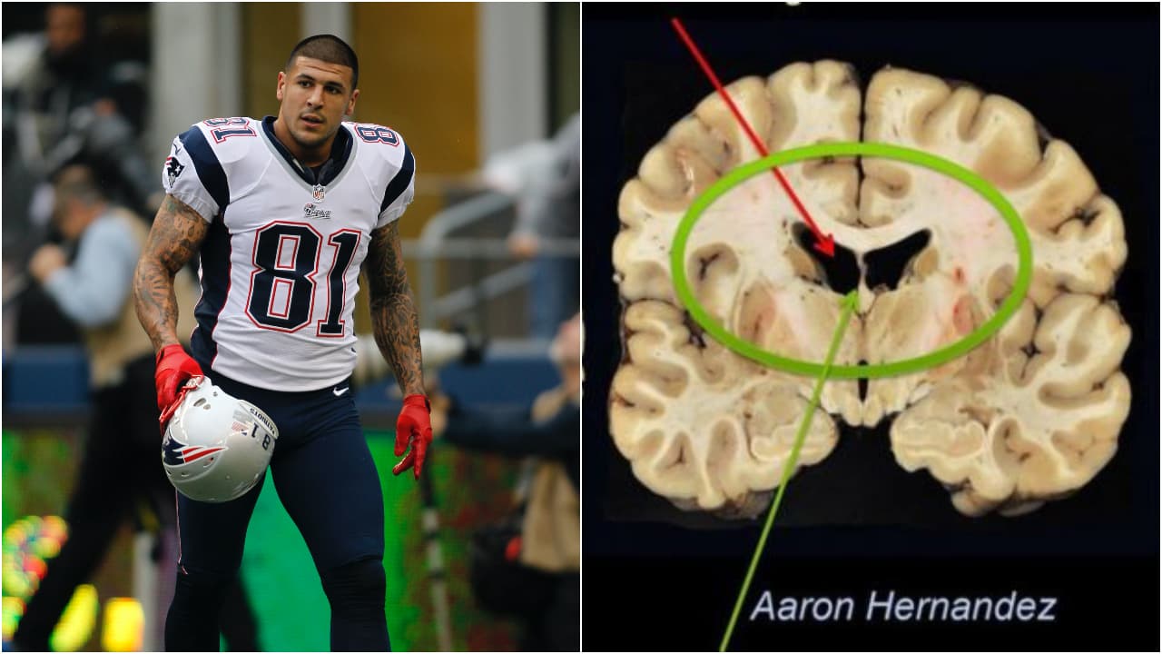<b>A dos años del desenlace final de Aaron Hernández</b>
<br>- Se cumplen justo 2 años de que la exsuper estrella de la NFL, Aaron Hernández, se quitara la vida en su celda.
<br>- Fue un 19 de abril de 2017 cuando así lo confirmó el Departamento de Prisiones en Massachusetts.
<br>- La vida de Hernández estuvo rodeada de factores que influyeron claramente en cada suceso.
<br>- Entre lo más destacado y, sobre lo que profundizaremos, es acerca del problema físico que trajo consecuencias severas hasta causarle la muerte.
