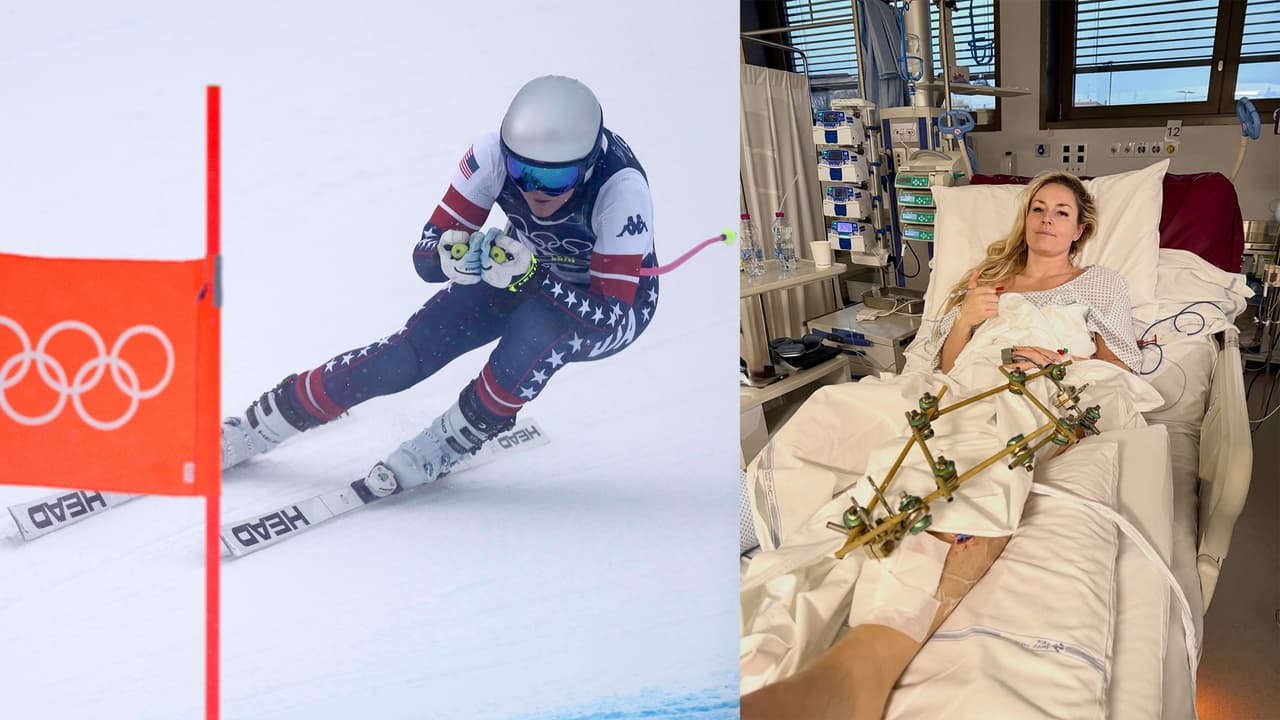 Lindsey Vonn tuvo su tercera cirugía desde su accidente en Milano Cortina 2026