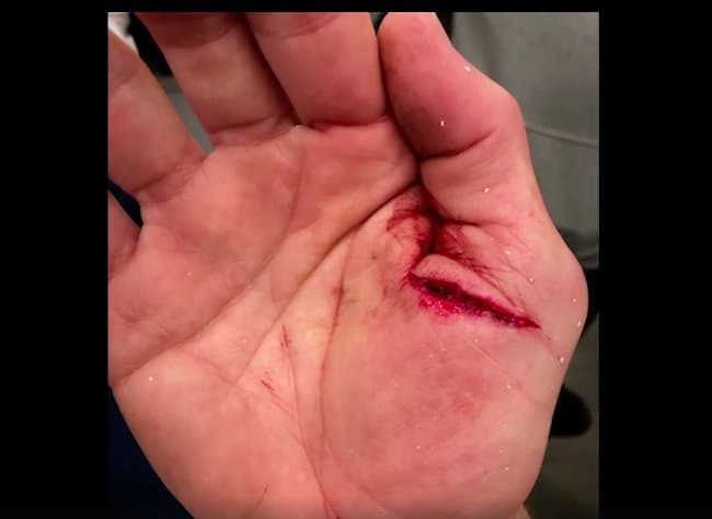 Así lucía la cortada en su pulgar.