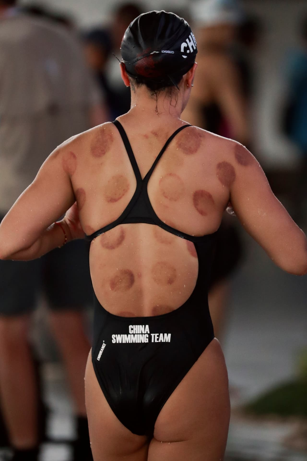 Algunos nadadores tienen puntos rojos producto de la "ventosaterapia", un tratamiento en el que se ponen vasos de vidrio calientes en el cuerpo con la idea de generar mejor circulación sanguínea.