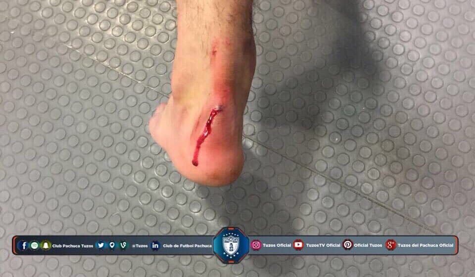El pie de Hirving Lozano tras el juego ante Puebla.