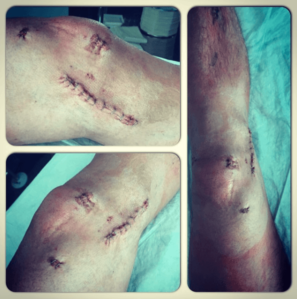 En una de las operaciones de rodilla de Andy Carroll, hoy compañero del Chicharito en West Ham, el delantero inglés compartió el estado dde sus heridas durante la recuperación.