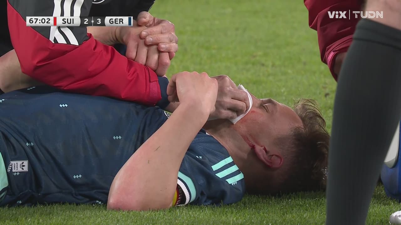 Le reventaron el labio a Joshua Kimmich y valiente siguió en el juego