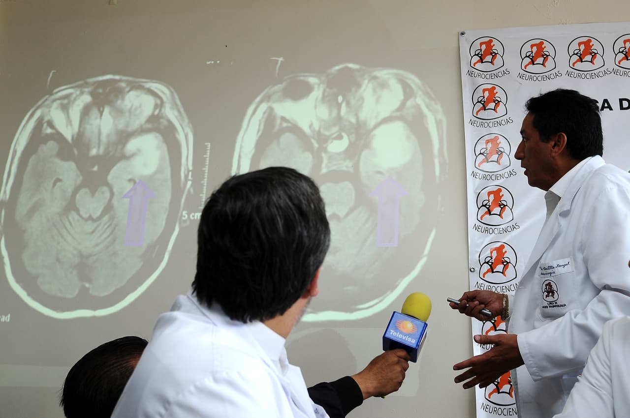 La trombosis es la formación de un coágulo en el interior de un vaso sanguíneo y uno de los causantes de un infarto agudo de miocardio. También se denomina así al propio proceso patológico, en el cual, un agregado de plaquetas o fibrina obstruye un vaso sanguíneo.