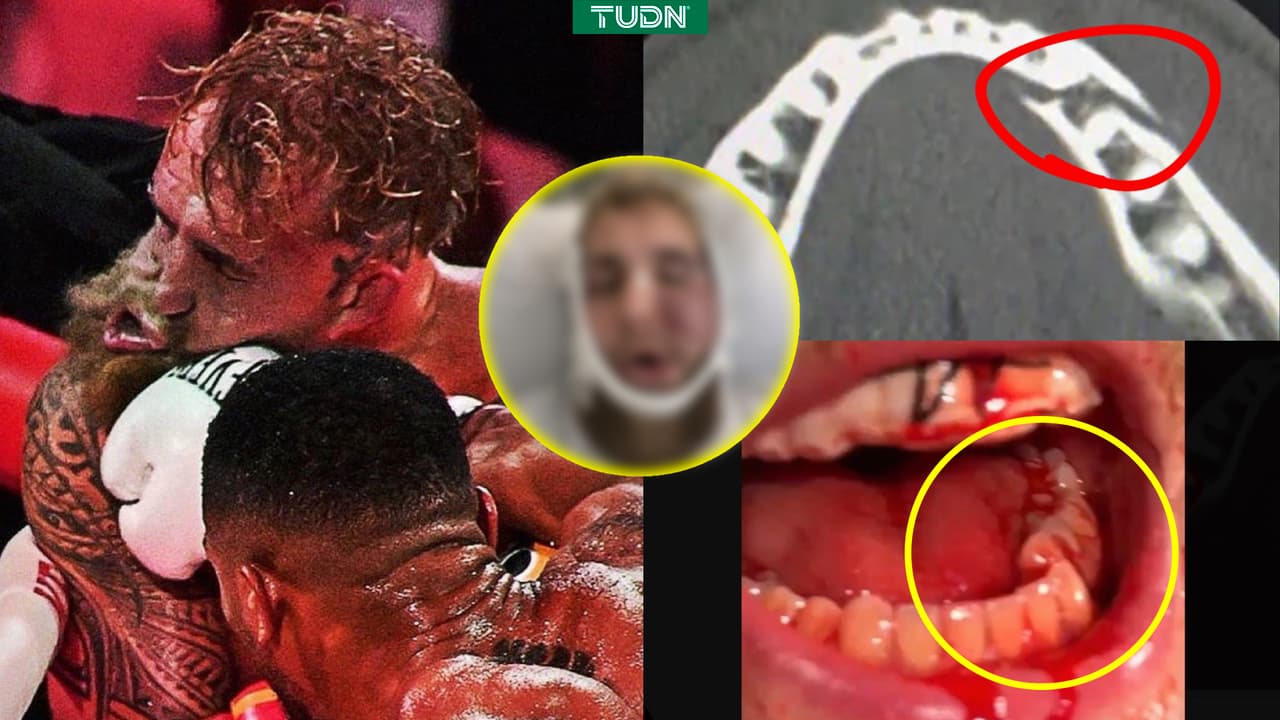 ¡Escalofriante! Así quedó el rostro de Jake Paul tras pelea vs. Anthony Joshua