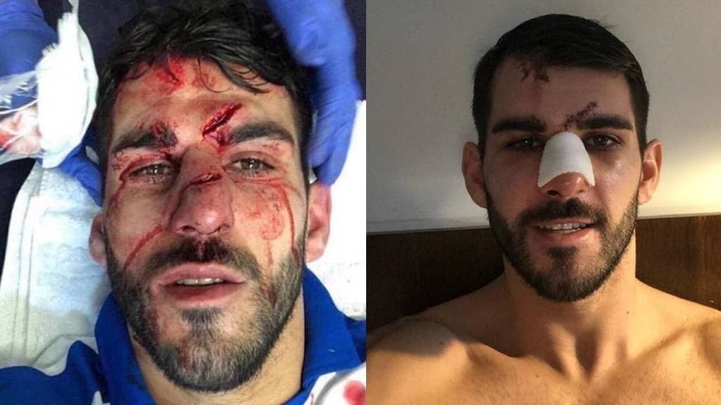 En un duelo entre Reading y Aston Villa, el portugués Nelson Oliveira recibió un pisotón en el rostro que lo dejó con tres heridas profundas las cuales compartió con sus seguidores en Instagram.