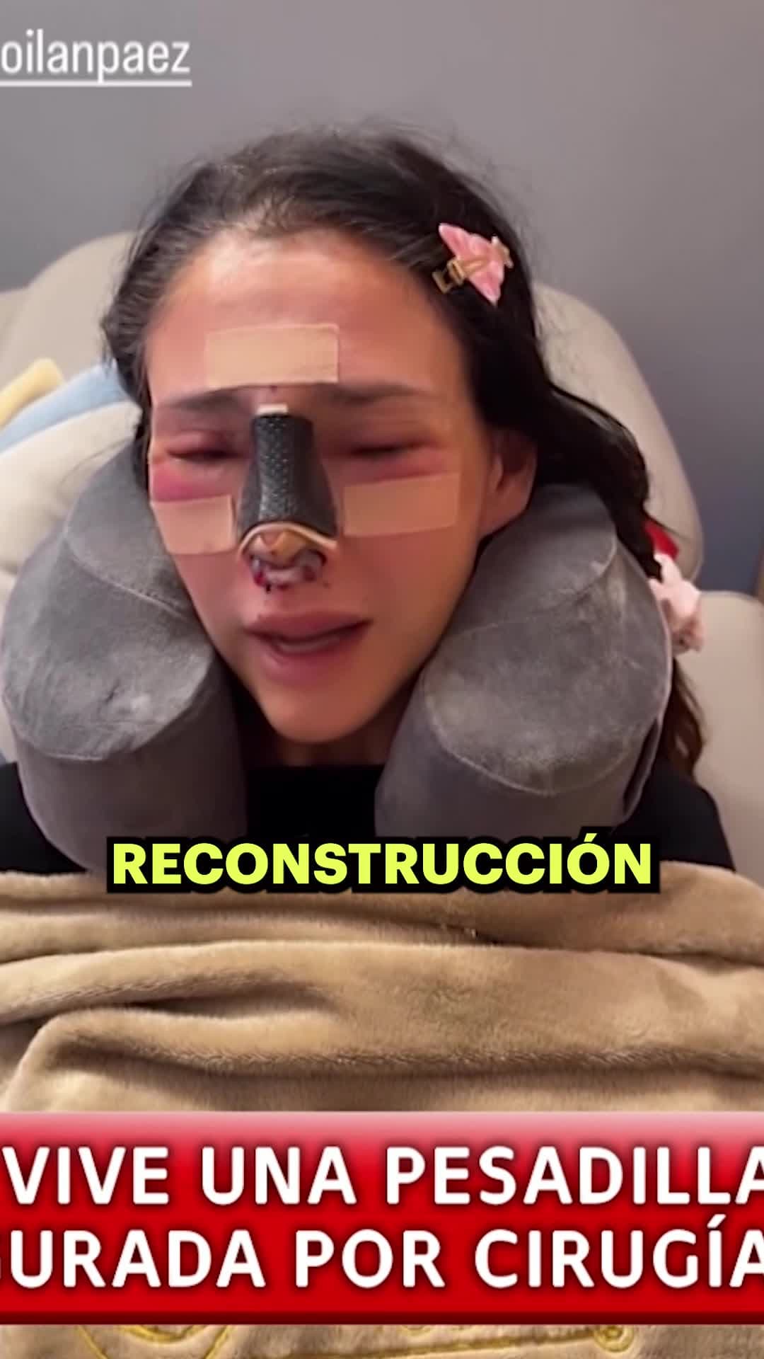 Dorismar reaparece con el rostro desfigurado tras una mala cirugía