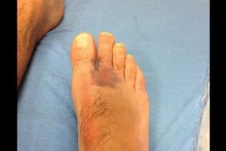 Márquez mostró el golpe en su pie derecho. (Foto: Twitter)