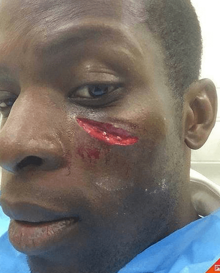 Jugando para los Queens Park Rangers, el defensa Nedum Onuoha recibió un golpe en el rostro que le dejó este recuerdito.
