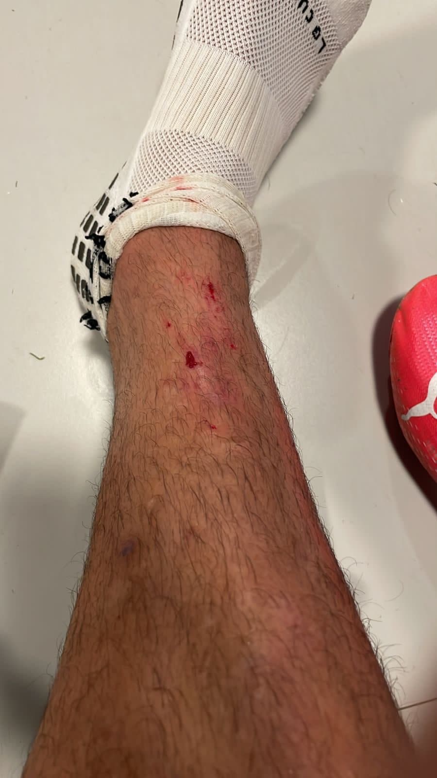 ¿Y el VAR? Dinenno "presume" herida en el pie